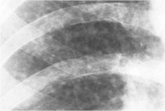 Silicosis simple, nódulos