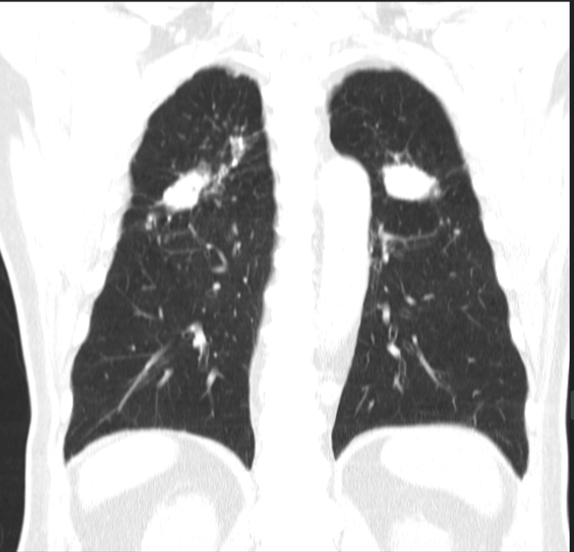 Silicosis complicada PMF en TAC
