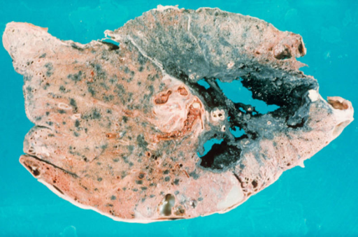 Corte de pulmón con fibrosis